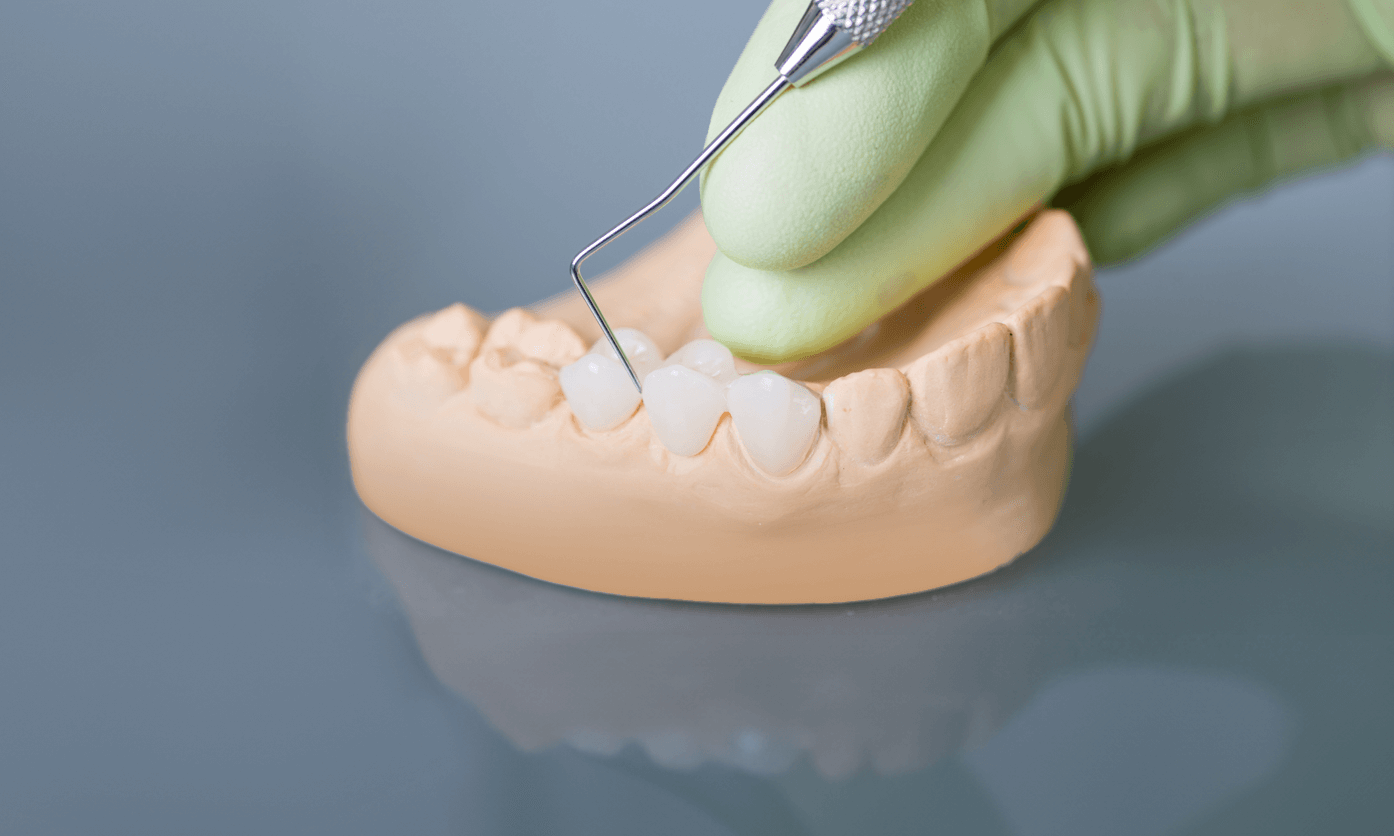 Dental bridge