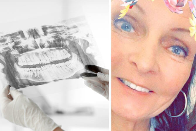 Modell av ett tandimplant